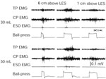 Figure 18 : Effect of esophago-UES contractile reflex on the UES closure muscles. Unfortunately we are unable to provide accessible alternative text for this. If you require assistance to access this image, or to obtain a text description, please contact npg@nature.com