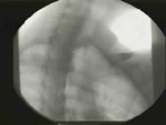 Video 1 : Videofluoroscopy of deglutition and primary peristalsis. Unfortunately we are unable to provide accessible alternative text for this. If you require assistance to access this image, or to obtain a text description, please contact npg@nature.com