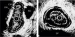 Figure 2 : Ultrasonographic images of the esophagus (left) and lower esophageal sphincter (LES, right). Unfortunately we are unable to provide accessible alternative text for this. If you require assistance to access this image, or to obtain a text description, please contact npg@nature.com