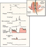 Figure 6 : Physiologic record of a spontaneous, transient relaxation of the LES. Unfortunately we are unable to provide accessible alternative text for this. If you require assistance to access this image, or to obtain a text description, please contact npg@nature.com