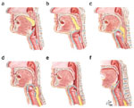 Figure 1 : Diagrammatic illustration of motor events of swallowing reflex. Unfortunately we are unable to provide accessible alternative text for this. If you require assistance to access this image, or to obtain a text description, please contact npg@nature.com