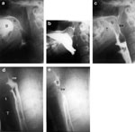 Figure 4 : Selected stop-frame prints from a cinepharyngogram demonstrate several stages of a normal swallow. Unfortunately we are unable to provide accessible alternative text for this. If you require assistance to access this image, or to obtain a text description, please contact npg@nature.com