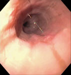 Figure 6 : A fairly normal-appearing esophagus in a patient with symptomatic nutcracker esophagus. Unfortunately we are unable to provide accessible alternative text for this. If you require assistance to access this image, or to obtain a text description, please contact npg@nature.com