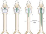 Figure 1 : Laryngeal clefts classification. Unfortunately we are unable to provide accessible alternative text for this. If you require assistance to access this image, or to obtain a text description, please contact npg@nature.com