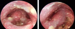 Figure 11 : Laryngopharyngeal candidiasis with characteristic plaques. Unfortunately we are unable to provide accessible alternative text for this. If you require assistance to access this image, or to obtain a text description, please contact npg@nature.com