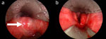 Figure 5 : Transoral laser assisted cricopharyngeal myotomy. Unfortunately we are unable to provide accessible alternative text for this. If you require assistance to access this image, or to obtain a text description, please contact npg@nature.com