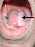 Figure 6 : Tongue reconstruction with radial forearm free flap. Unfortunately we are unable to provide accessible alternative text for this. If you require assistance to access this image, or to obtain a text description, please contact npg@nature.com
