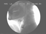 Video 1 : Videoswallow and corresponding manometric traces from a patient with mild dysphagia and failed UES relaxation due to syringobulbia. Unfortunately we are unable to provide accessible alternative text for this. If you require assistance to access this image, or to obtain a text description, please contact npg@nature.com