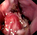 Figure 6 : Postendoscopic resection appearance of the Zenker's diverticulum. Unfortunately we are unable to provide accessible alternative text for this. If you require assistance to access this image, or to obtain a text description, please contact npg@nature.com