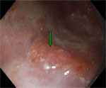 Figure 2 : Closer view of the nodular mucosa of Barrett's adenocarcinoma (green arrow) using high-resolution endoscopy Unfortunately we are unable to provide accessible alternative text for this. If you require assistance to access this image, or to obtain a text description, please contact npg@nature.com