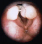 Figure 1 : Laryngeal granulomas in a patient with numerous episodes of pharyngeal acid exposure and no history of intubation. Unfortunately we are unable to provide accessible alternative text for this. If you require assistance to access this image, or to obtain a text description, please contact npg@nature.com