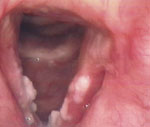 Figure 10 : A nonsmoker with severe pH probe documented LPR and squamous cell carcinoma on both true vocal folds. Unfortunately we are unable to provide accessible alternative text for this. If you require assistance to access this image, or to obtain a text description, please contact npg@nature.com