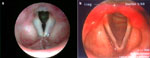 Figure 3 : a: Ventricular obliteration is secondary to edema of the true vocal folds and false vocal cords. Unfortunately we are unable to provide accessible alternative text for this. If you require assistance to access this image, or to obtain a text description, please contact npg@nature.com