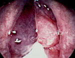 Figure 4 : Intraoperative photo of polypoid degenerations of the true vocal folds (Reinke's edema). Unfortunately we are unable to provide accessible alternative text for this. If you require assistance to access this image, or to obtain a text description, please contact npg@nature.com