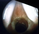 Figure 9 : A patient with subglottic stenosis with no history of intubation of trauma. Unfortunately we are unable to provide accessible alternative text for this. If you require assistance to access this image, or to obtain a text description, please contact npg@nature.com