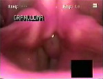 Video 1 : Left vocal process granuloma, which responded well to antireflux therapy and speech therapy. Unfortunately we are unable to provide accessible alternative text for this. If you require assistance to access this image, or to obtain a text description, please contact npg@nature.com