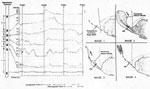 Figure 20 : Concurrent manometric and videofluorographic recording of a 10-mL barium swallow in a subject with a reducing hiatal hernia characterized by late retrograde flow. Unfortunately we are unable to provide accessible alternative text for this. If you require assistance to access this image, or to obtain a text description, please contact npg@nature.com