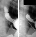 Figure 4 : Radiograph of a patient with a small axial hiatal hernia (case 1). Unfortunately we are unable to provide accessible alternative text for this. If you require assistance to access this image, or to obtain a text description, please contact npg@nature.com