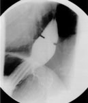 Figure 5 : Radiograph of a patient with a small axial hiatal hernia (case 2). Unfortunately we are unable to provide accessible alternative text for this. If you require assistance to access this image, or to obtain a text description, please contact npg@nature.com