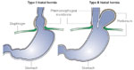 Figure 7 : Sliding versus paraesophageal hiatal hernia. Unfortunately we are unable to provide accessible alternative text for this. If you require assistance to access this image, or to obtain a text description, please contact npg@nature.com