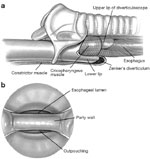 Figure 15 : Method of endoscopic cricopharyngeal myotomy. Unfortunately we are unable to provide accessible alternative text for this. If you require assistance to access this image, or to obtain a text description, please contact npg@nature.com