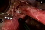 Video 2 : Esophageal dissection. Unfortunately we are unable to provide accessible alternative text for this. If you require assistance to access this image, or to obtain a text description, please contact npg@nature.com