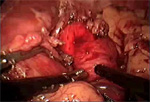 Video 3 : Myotomy. Unfortunately we are unable to provide accessible alternative text for this. If you require assistance to access this image, or to obtain a text description, please contact npg@nature.com