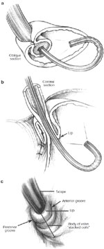 Figure 2 : a. An endoscopic view of a 360-degree fundoplication. Unfortunately we are unable to provide accessible alternative text for this. If you require assistance to access this image, or to obtain a text description, please contact npg@nature.com