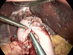 Figure 4 : Nissen fundoplication. Unfortunately we are unable to provide accessible alternative text for this. If you require assistance to access this image, or to obtain a text description, please contact npg@nature.com