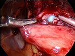 Figure 5 : Intraoperative view of an esophageal perforation. Unfortunately we are unable to provide accessible alternative text for this. If you require assistance to access this image, or to obtain a text description, please contact npg@nature.com