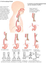 Figure 10 : Main types of tracheoesophageal fistulae Unfortunately we are unable to provide accessible alternative text for this. If you require assistance to access this image, or to obtain a text description, please contact npg@nature.com