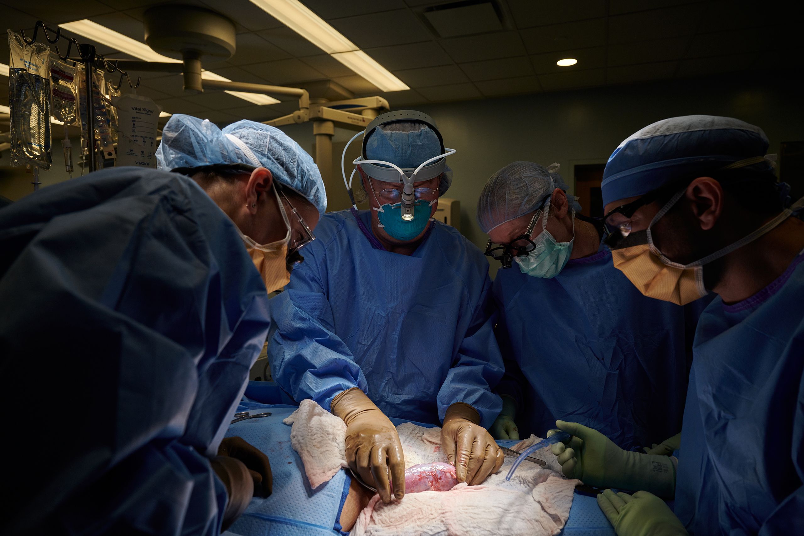 Τέσσερις χειρουργοί πραγματοποιούν μεταμόσχευση νεφρού χοίρου σε ασθενή στο NYU Langone