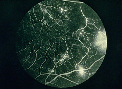 视网膜荧光血管造影显示糖尿病视网膜病变严重程度为 1-A，与糖尿病相关。 血管造影显示明显的多个微动脉瘤。