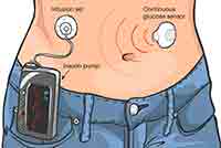 Illustration of a wearable artificial pancreas system with an insulin pump and glucose sensor.