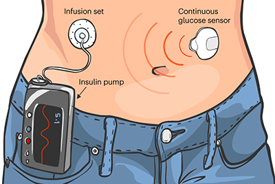 带有胰岛素泵和葡萄糖传感器的可穿戴人工胰腺系统示意图。