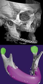 A 3-D scan was taken of the patient's jaw (upper) and used to generate a virtual jawbone (lower).