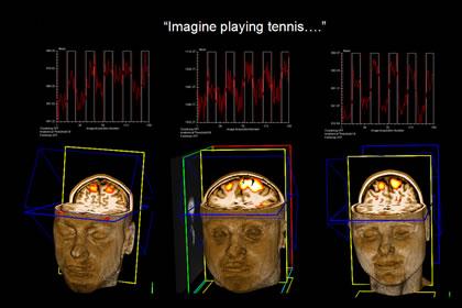 Three healthy participants at the MRC Cognition and Brain Sciences Unit show increased activity in the motor areas of the brain when asked to imagine playing tennis. The activation observed in the vegetative patient was identical.