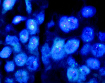 This fluorescence micrograph shows approximately 30 breast cancer tumor cells. The bodies of the cells appear bright blue against a black background. The green control signal and the orange Her2/neu signals appear as points and clusters within the cells.