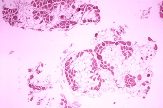 A photomicrograph shows a cross-section of muscle cells stained with pink dye. The cells look like many square compartments, much like cork. Some of the compartments are muscle cells and appear as a dark, solid pink color. However, many of the muscle cells have been replaced with adipose cells, which are a light, translucent color.