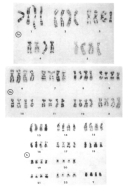 A photomicrograph shows human chromosome pairs lined up in a karyotype. The chromosomes have been stained so their banding patterns are visible. The chromosomes are arranged in horizontal rows in homologous pairs and appear as grey, black, and white X-shaped structures against a white background; some of the chromosomes have a dark black circle in their center indicating the position of the centromere. The chromosomes appear to have grey and white striations along their arms.