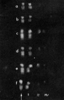 A fluorescent karyotype shows chromosome pairs 9 and 22 as white against a black background in six rows labeled A through F. The two chromosome pairs are arranged side-by-side in each row so that single chromosomes each occupy a column. Columns 1 and 2 contain chromosomes 9. Columns 3 and 4 contain chromosomes 22. Chromosome 9 is marked by a white arrow in the first column below row F. The chromosomes in rows A and B are about half the length of the chromosomes in rows C through F. The chromosome in the fourth column of each row is the Philadelphia chromosome (a variant in the chromosome 22 pair, denoted as Ph1). It is undetectable in rows A and B. In row C, it appears as a circular smudge approximately 25 percent the length of chromosomes 9. In rows D through F, it appears as a small, circular dot.