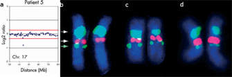 A four-panel figure contains a computer-generated data plot and three photomicrographs of chromosome 17 (with its homologous partner). The chromosomes were subjected to Fish analysis and appear fluorescent blue against a black background. Light blue, pink, and green fluorescent staining mark specific regions along the chromosomes. Absence of staining where it appears at the same site in the chromosome of other individuals suggests a deletion event has occurred.