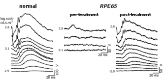 Three side-by-side electroretinography (ERG) diagrams show retinal responses in normal dogs, in RPE65 mutant dogs, and in RPE65 mutant dogs after subretinal AAV-RPE65 therapy. The retinal responses are represented in each diagram as parallel, horizontal lines. Each line has the property of a wave; peaks indicate higher retinal responses, and flat lines indicate the absence of a response. ERGs in the normal dogs indicate an increased retinal response with increasing retinal stimulation. ERGs in the RPE65 mutant dogs are flat or exhibit a single small peak even at the highest stimulation. ERGs in the RPE65 mutant dogs after retinal therapy resemble the pattern of ERGs shown in the normal diagram, although the response is not as large.