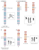 Four ideograms show potential modifications of chromosomes. Each ideogram is accompanied by a black-and-white photomicrograph of normal and modified chromosomes. Chromosomes are depicted as vertical cylinders composed of colored bands. The colored bands represent specific regions of DNA. Deletions and inverted duplications of chromosomes 15 and 22 result in specific disease phenotypes.
