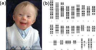Panel A is a photograph of a child with Down syndrome. He is wearing a blue collared shirt, white sweater vest with an argyle pattern, and is smiling at the camera. He has the typical almond-shaped eyes associated with Down syndrome. Panel B is an idiogram of all the chromosomes in a person with Down syndrome. Chromosomes 1 through 20 and 22 occur as homologous pairs. However, there are three homologs of chromosome 21. Each set of chromosomes has a specific light-dark banding pattern.