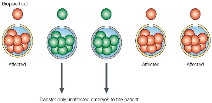 A schematic shows five embryos. Each embryo is represented as a circle containing seven spherical cells. Cells that test negatively for a genetic disease contain cells that are shaded green; cells that test positively for a genetic disease contain cells that are shaded red. An eighth cell, representing the biopsied cell, has been removed and is shown above each embryo. Embryos that contain red cells are labeled as affected with disease. Three of the five embryos are affected with disease; the two unaffected embryos are the only embryos transferred to the patient.