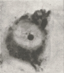 In this micrograph of a motor neuron nucleus, the nucleolus appears as a dark circle at the center of the nucleus against a gray background. Adjacent to the nucleolus is a small dark circle, indicated by an arrow, which is known as a nucleolar satellite or Barr body.
