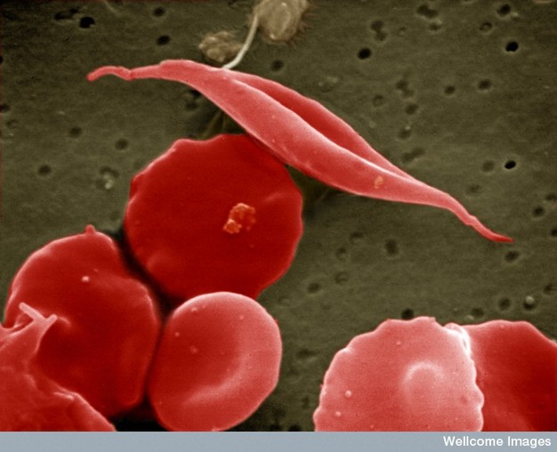 A scanning electron photomicrograph shows seven red blood cells. Five of the red blood cells appear healthy and are shaped like concave discs. The sixth red blood cell is concave at its center, but is elongated and misshapen. It is shaped like a pea pod with two pointed ends that extend outward. The seventh cell is only partially visible at the lower left corner of the image. It has a point protruding from it, and is likely to have a sickled shape as well.