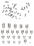 A photomicrograph shows 46 chromosomes arrested in metaphase. Each chromosome has an X-shape, formed by two condensed, side-by-side sister chromatids. The chromatids are pinched inward and are connected to each other at the centromere. The centromere is located between the middle and the top of the sister chromatid pair. Below the array of chromosomes is the karyotype, showing each homologous pair arranged by number.