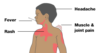 Four symptoms of dengue fever are indicated on an illustration of a male child. The child is shown from the waist up, and his head is turned in profile. A thermometer extends from his mouth, indicating he may have a fever. The skin along the child's left ribcage, the outer region of his left upper-arm, the center of his chest, his right shoulder, and his jawline are covered in red patches, indicating a rash. Parallel red lines above the child's left shoulder represent muscle and joint pain. A labeled line pointing towards the child's head represents a headache.
